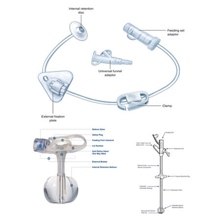 gastrostomia